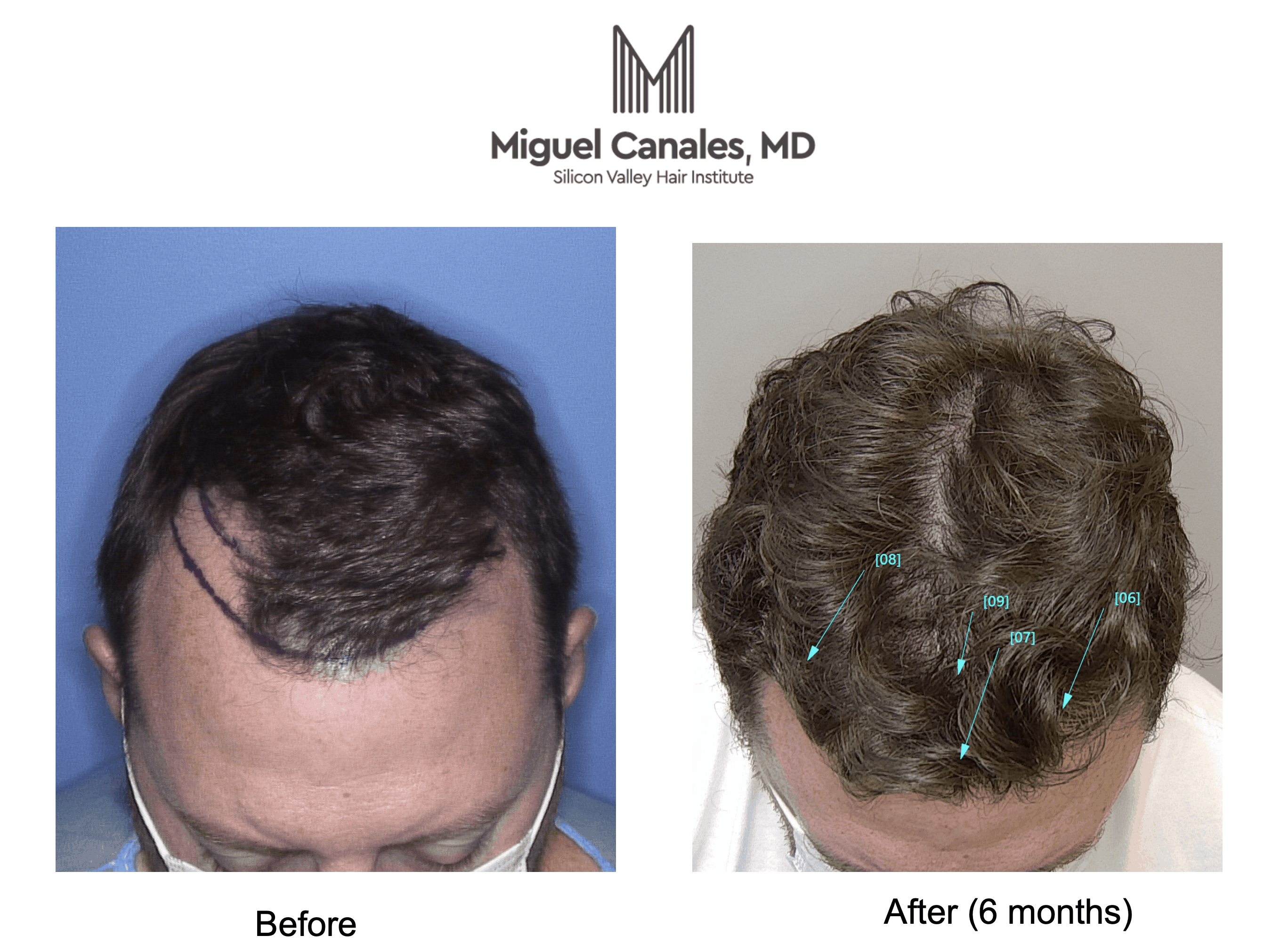 If You Suffer Hair Loss, It Is Worth Going to See a Top Specialist - Miguel  Canales .
