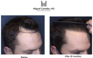 Photograph showing before and after a hair transplant; Male, San Francisco, California.
