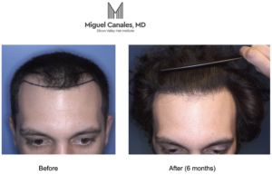 Campbell CA hair transplant before and after photo of a man