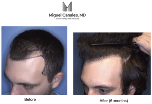 FUE (Follicular Unit Extraction) as a remedy for male pattern baldness