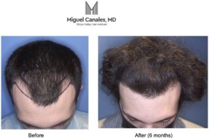 Cost of a hair transplant in the Bay Area
