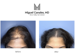 female hair loss specialist in San Francisco Bay Area