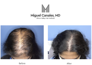  Women, too, can suffer from hair loss. Perhaps a female hair transplant might be your best option.