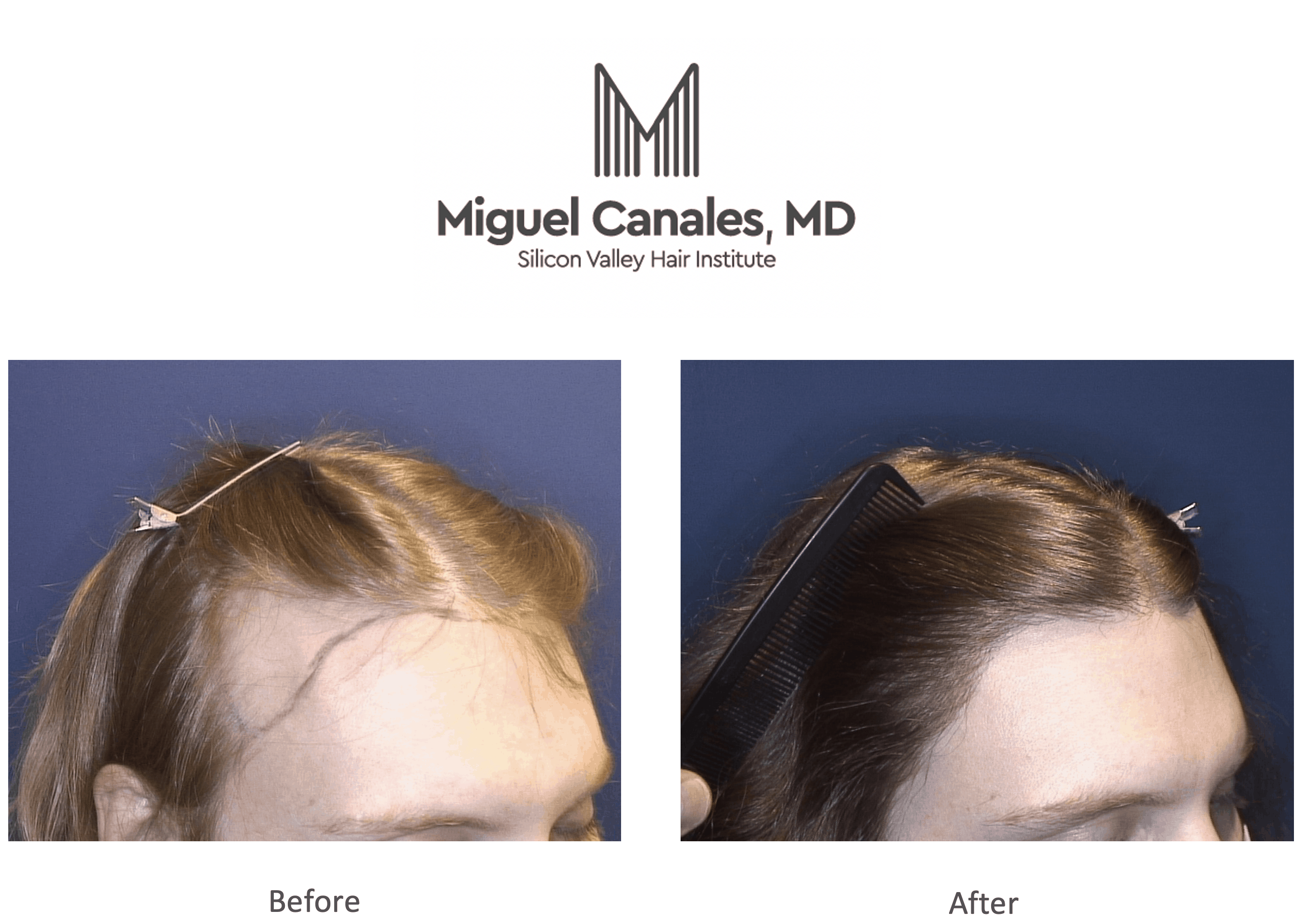 Hair Transplant Results - Before and After Photos - Video