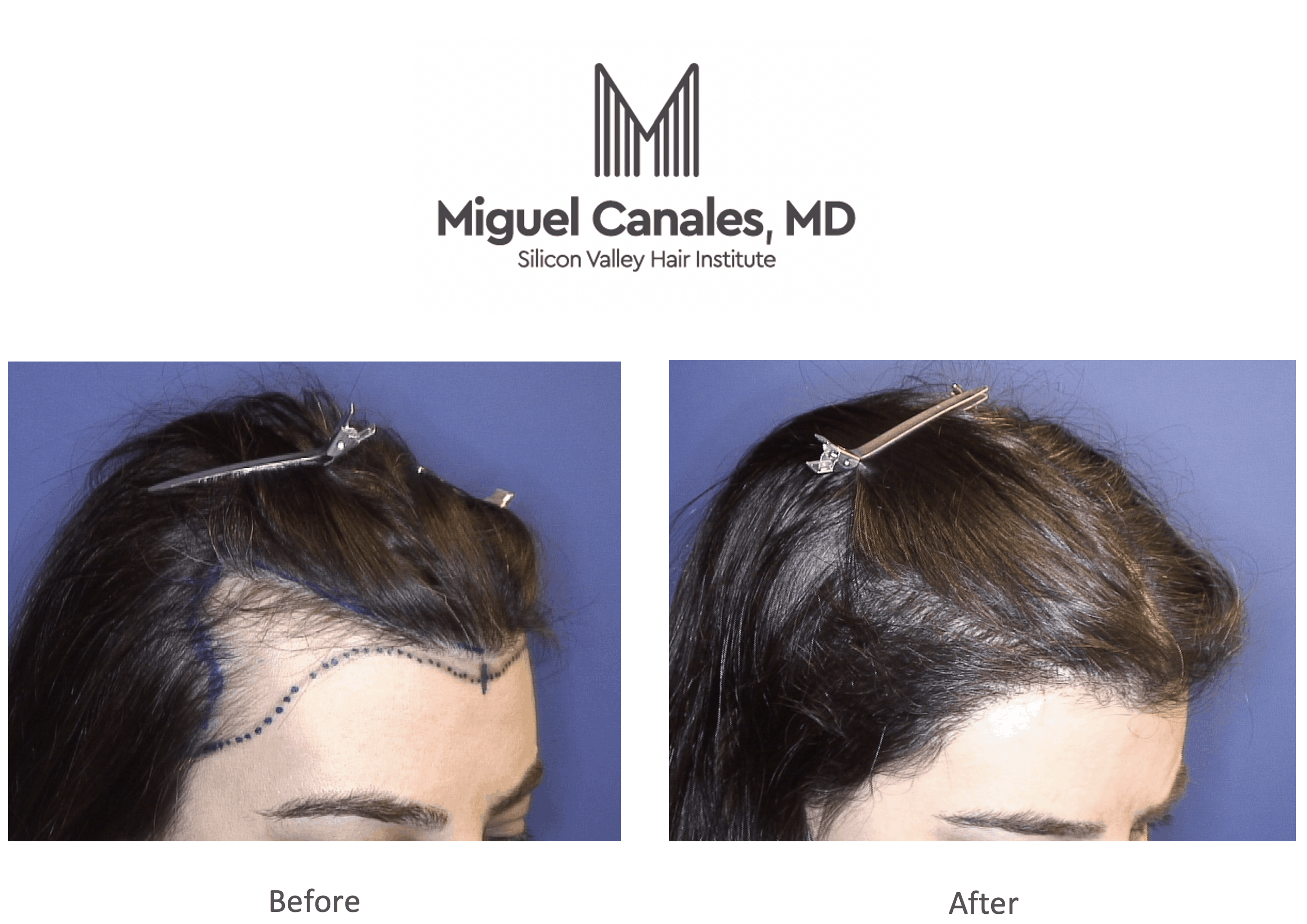 If You Are Suffering From Hair Loss, Take Comfort That You Are Not Alone -  Miguel Canales .