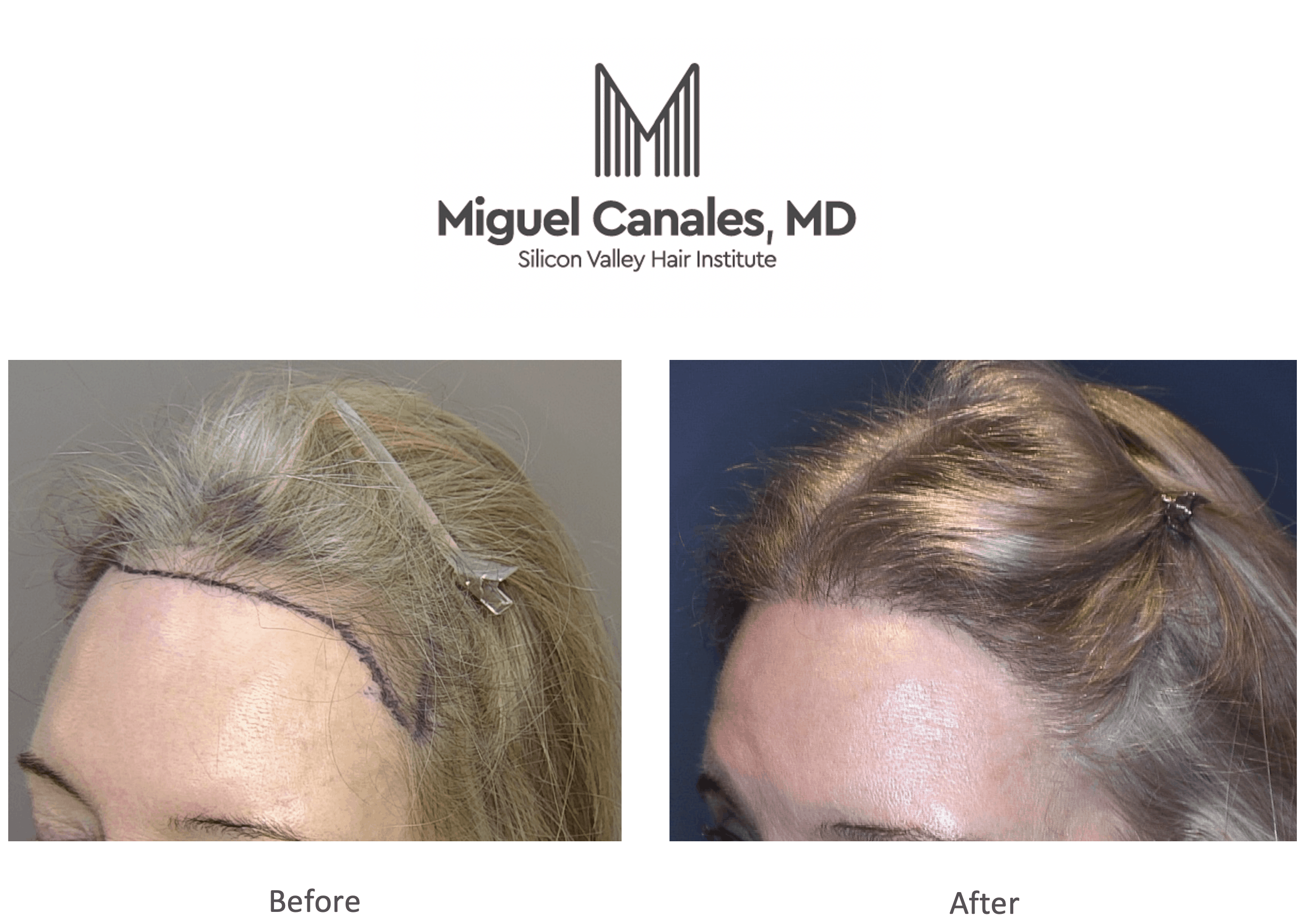 You May Need an Artas Hair Transplant, but Don't Understand What That Is -  Miguel Canales .