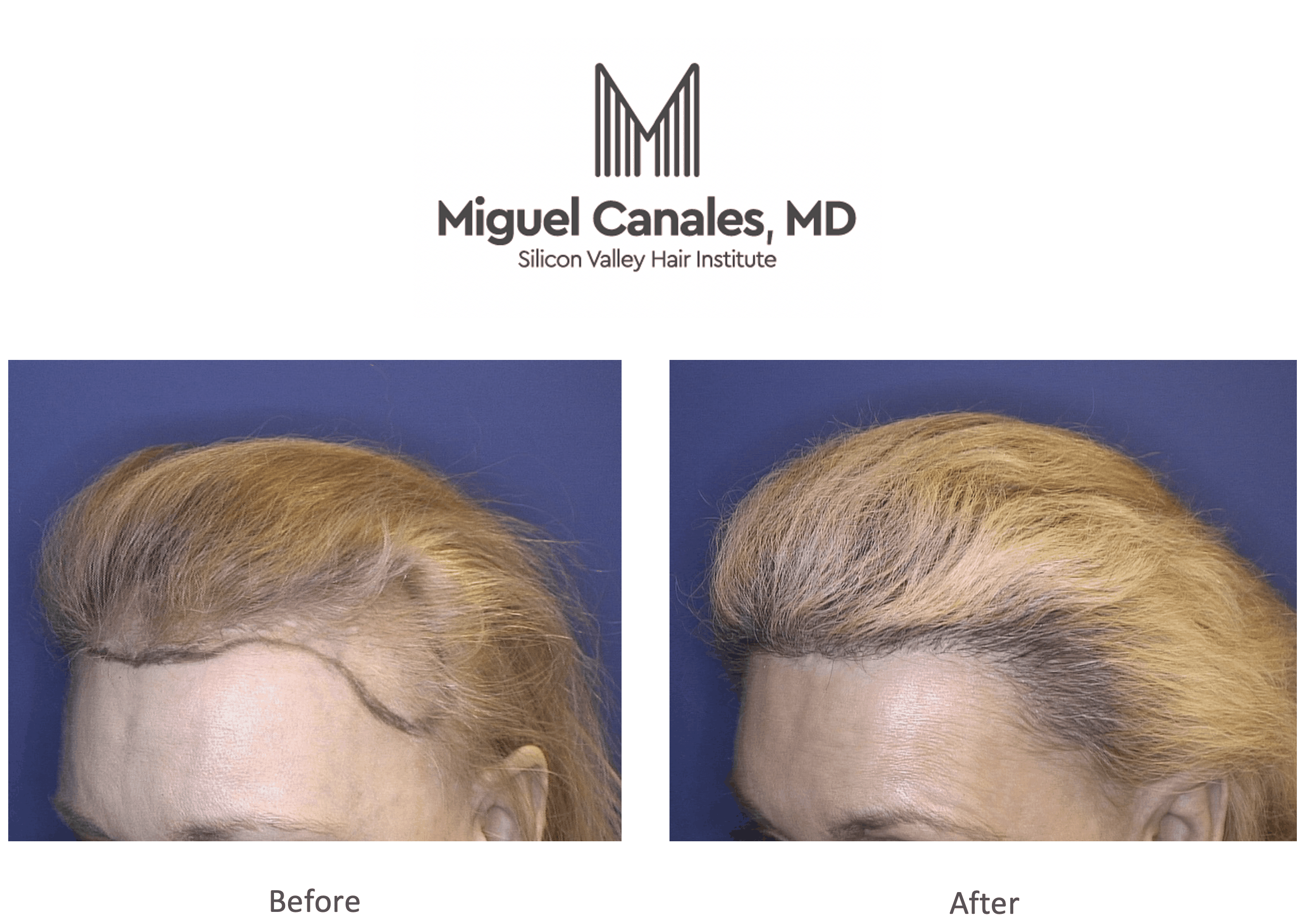 Silicon Valley Institute Announces Update to Bay Area Hair Transplant  Reviews Page - Miguel Canales .