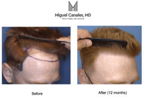 hair transplant picture - before and after