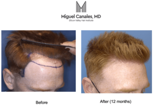 hair transplants work even for men with red hair