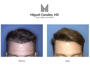 A hair transplant can completely restore hair to those bald patches in men. 