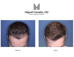  Hair transplants can now be carried out by a robot, that is robotic hair transplantation.