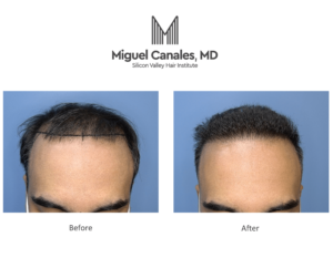 Don’t look for a cheap hair transplant in the Bay Area. Go for quality.
