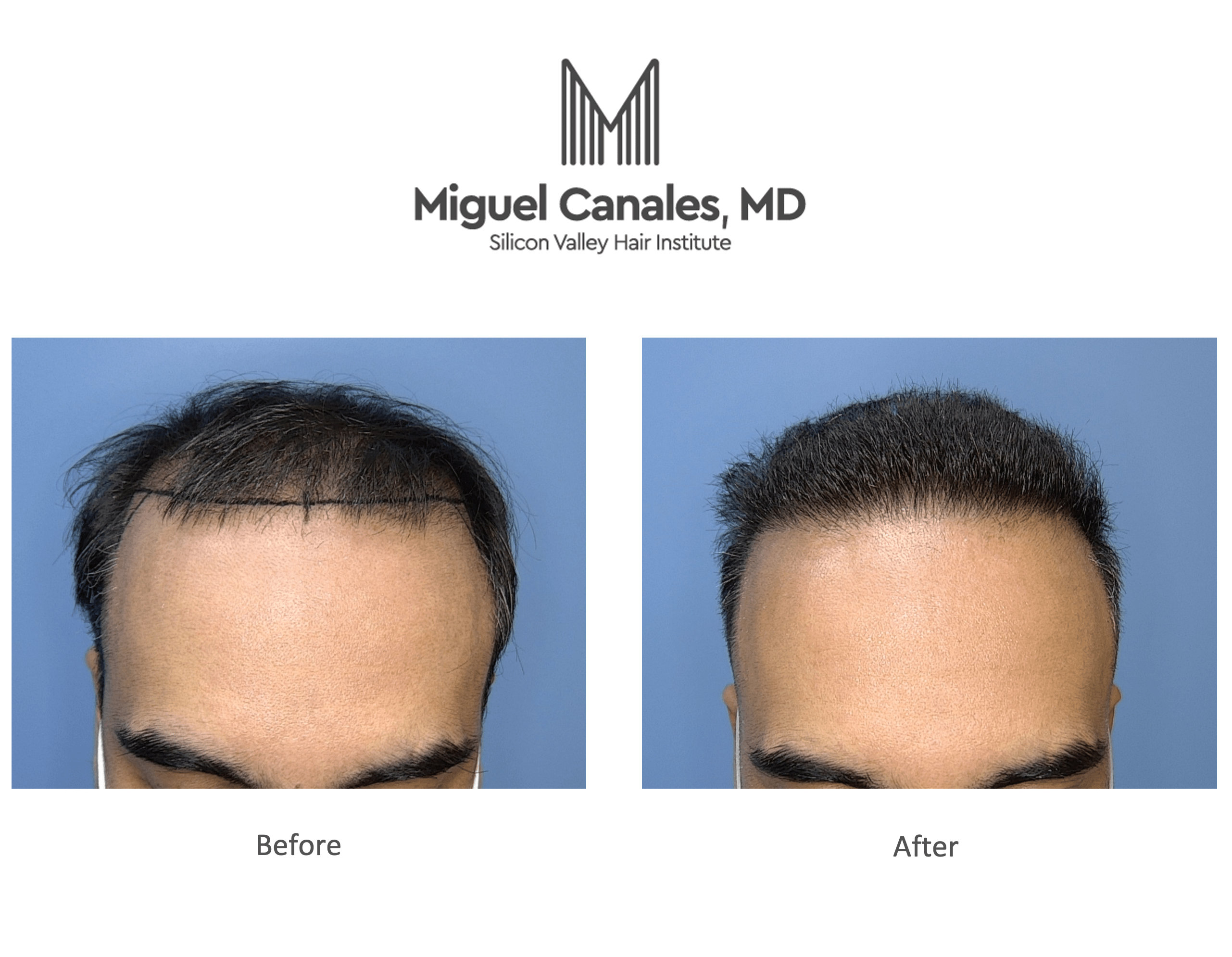 A Hair Transplant Is Important, so Don't Go to Mexico or Turkey! - Miguel  Canales .
