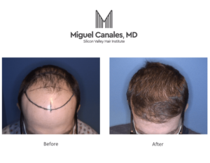 hair transplant photos before and after