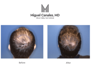 Your hair transplant may last a lifetime