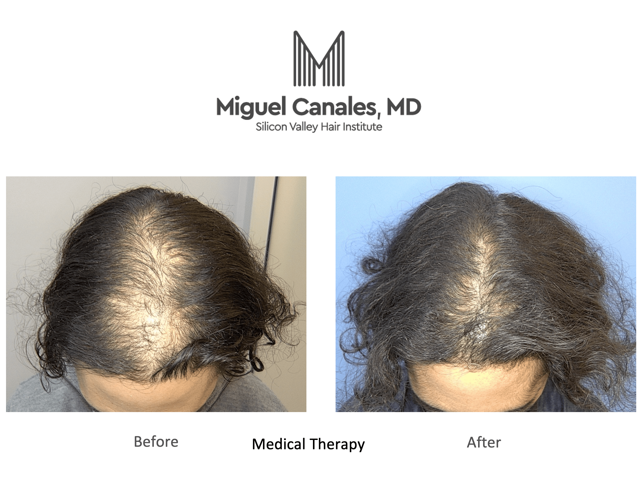 San Francisco Is an Expensive City, but You Can Still Get Affordable Hair  Loss Solutions - Miguel Canales .