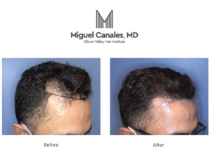 The Best Place for an ARTAS Hair Transplant in the Bay Area Is Foster City  - Miguel Canales .