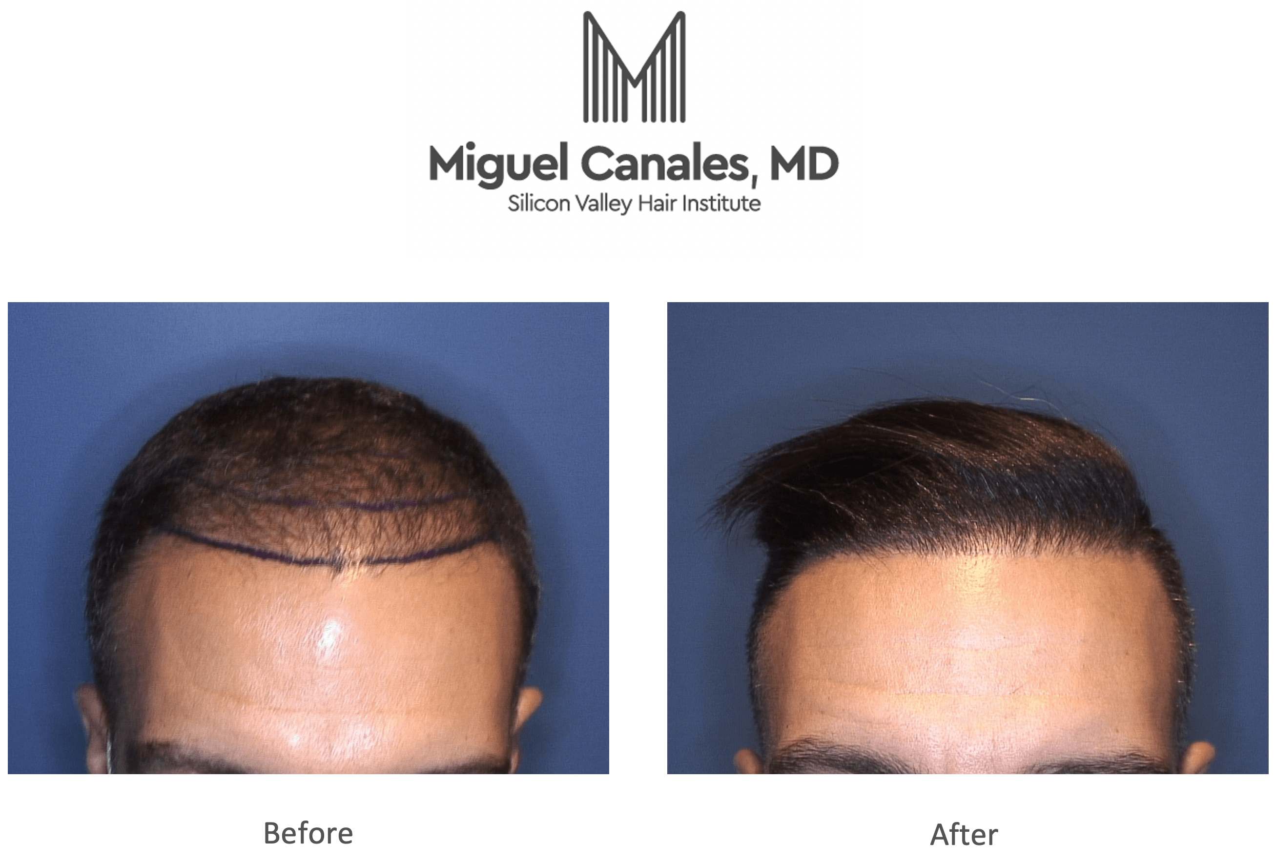 Secondary or Repair FUE | Maral Hair