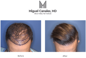hair transplant before and after 