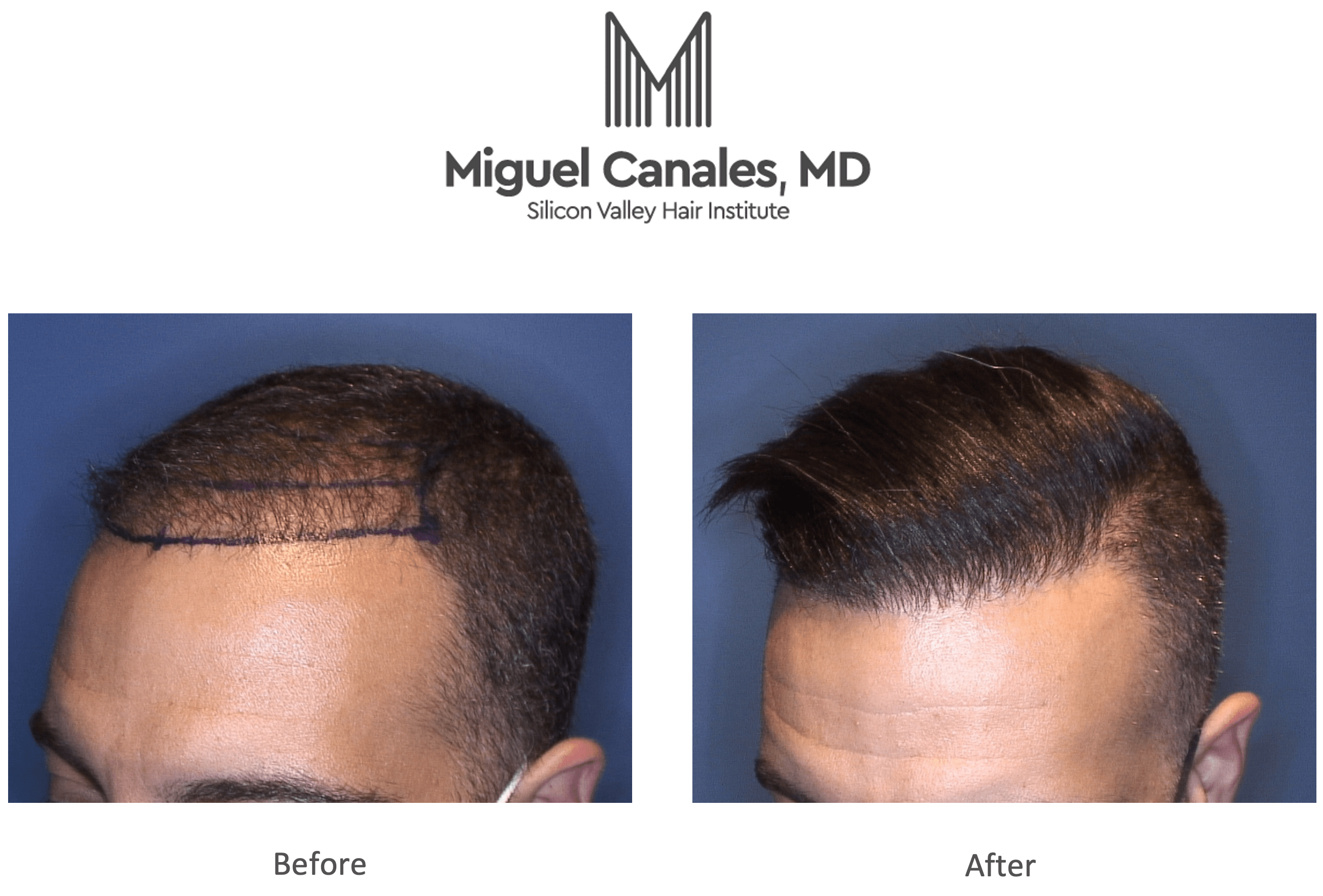 Silicon Valley Institute Announces New Bay Area Hair Transplant Reviews to  Reach Milestone - Miguel Canales .