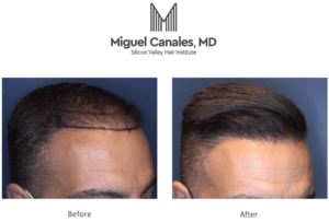 Foster City is convenient for a Bay area hair transplant.