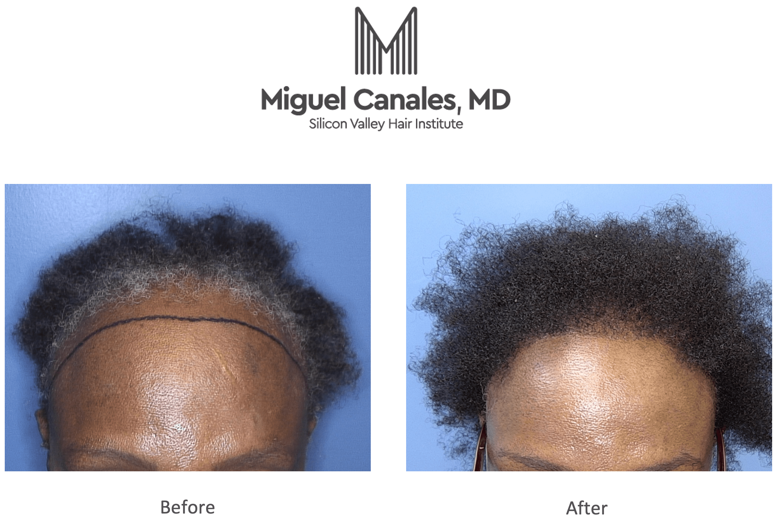 Generally Speaking, Women Don't Have Bald Patches, but Thinning Hair -  Miguel Canales .