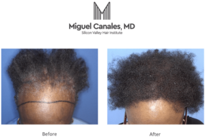 A hair transplant for African Americans in the San Francisco Bay Area