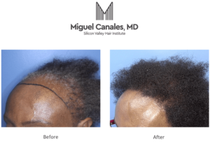 Silicon Valley Hair Institute, Listed as One of the Best Hair Transplant  Clinics in California, Announces New Post about Next Gen Hair Loss  Restoration