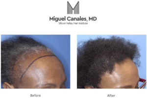 All types of hair transplantation, including African American hair transplants.