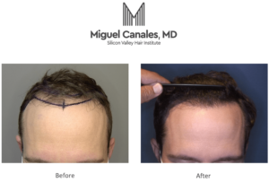 A follicular unit extraction specialist and a hair loss doc are the same