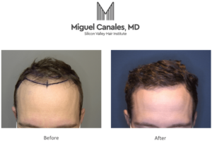 Finding the best hair transplant specialist in San Francisco is easy. 