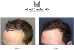 A hair transplant is the best New Year Resolution you could make.