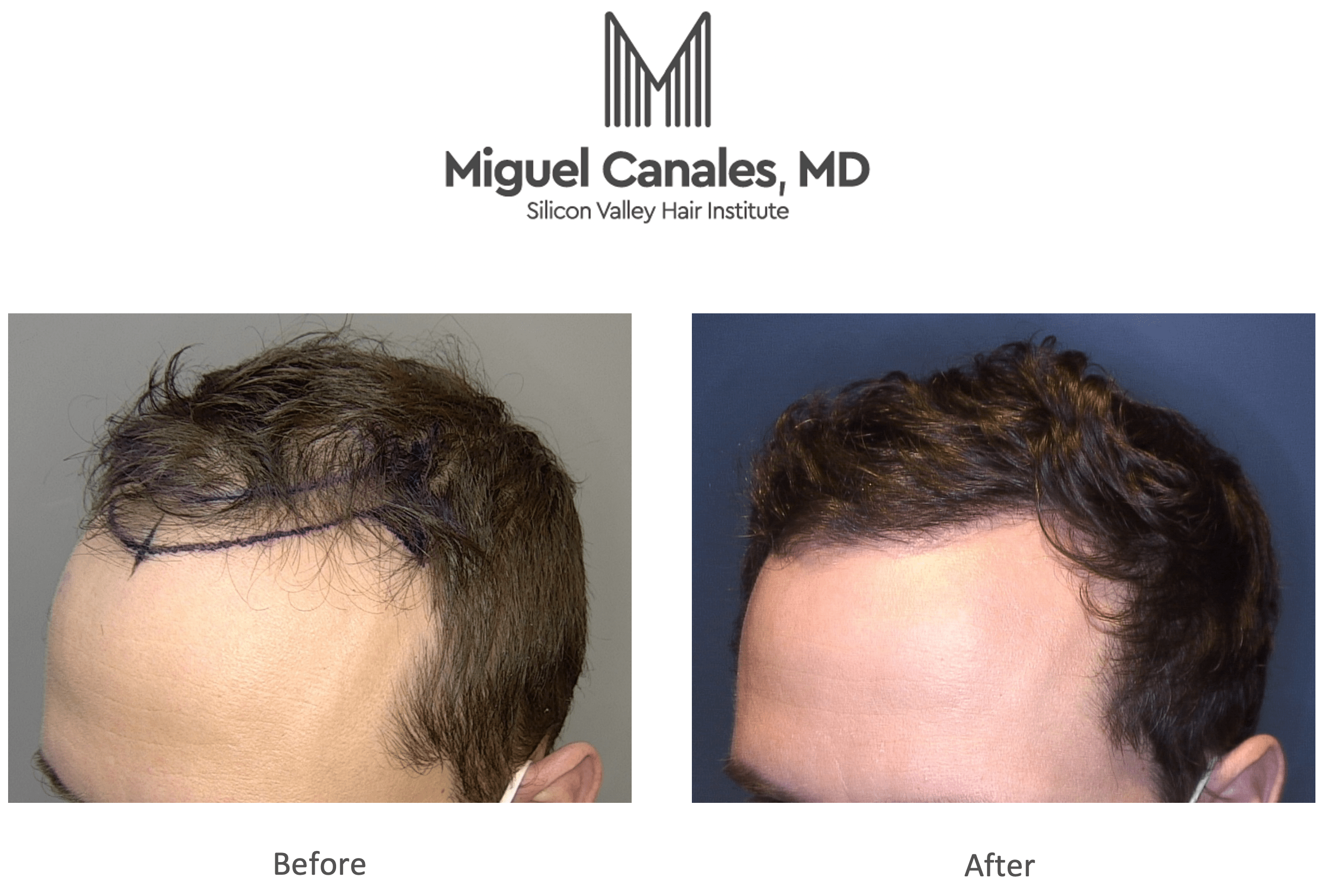 The Best New Year Resolution You Can Make Is to Get a Hair Transplant -  Miguel Canales .