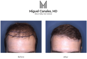 There are many options for the treatment of hair loss.