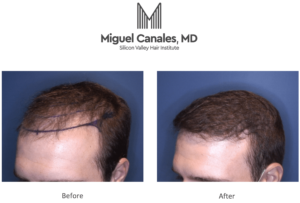  There is no “one size fits all” when it comes to hair transplants.