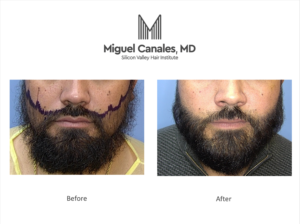 Bay Area beard transplant (facial hair transplant)
