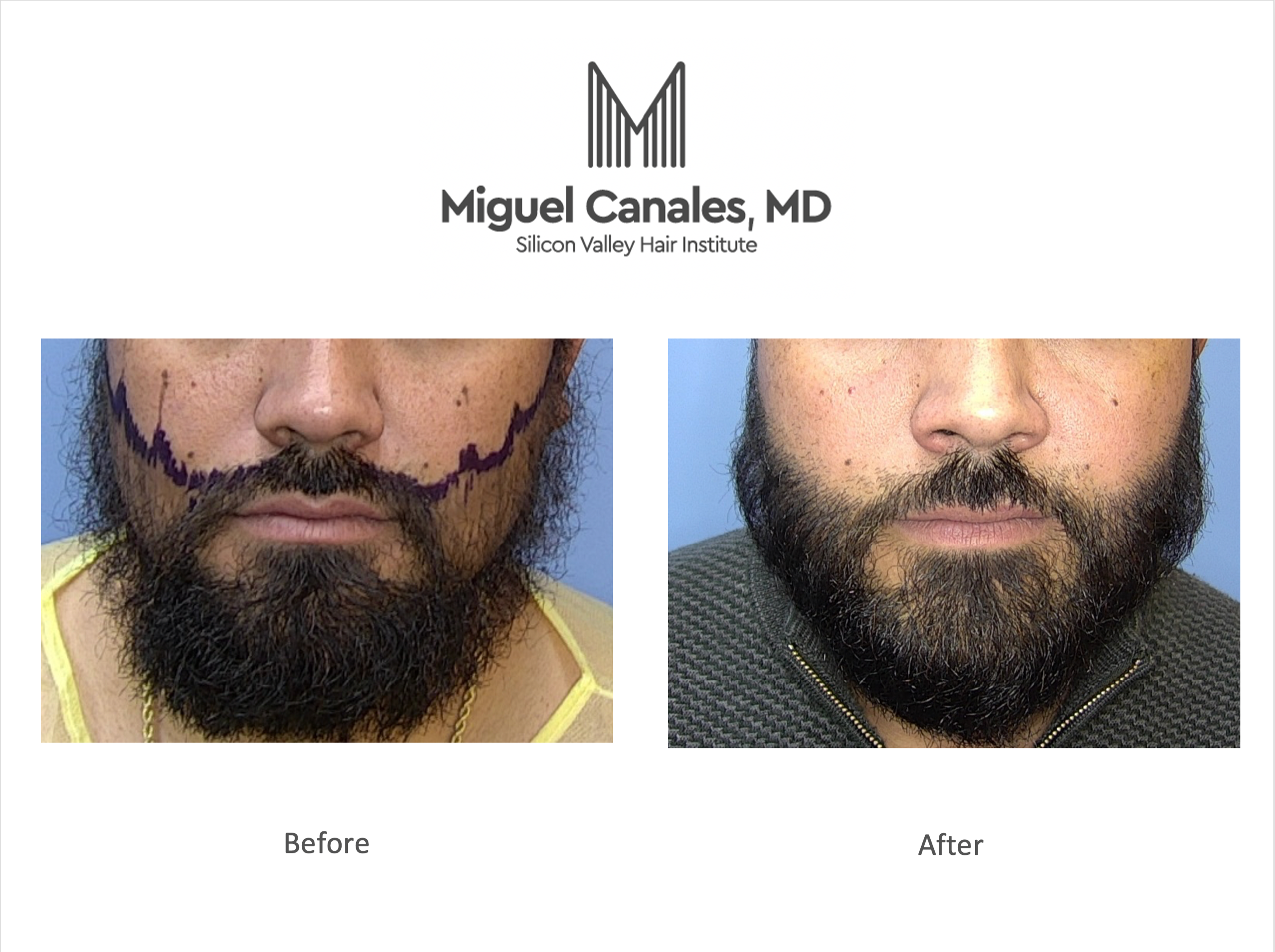 Beard  Facial Hair Transplants  McGrath Medical