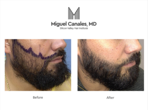 A facial hair transplant can give you the bushy beard that you seek.